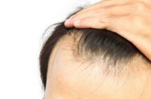 درمان ریزش مو و افزایش رویش مجدد با گیت پی